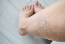 Kada operacija tampa neišvengiama sergant venų ligomis? Venų operacija – matomi venų pakitimai ir kraujotakos sutrikimo požymiai kojoje