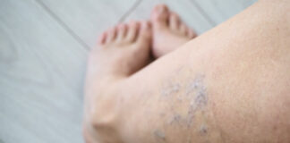 Kada operacija tampa neišvengiama sergant venų ligomis? Venų operacija – matomi venų pakitimai ir kraujotakos sutrikimo požymiai kojoje