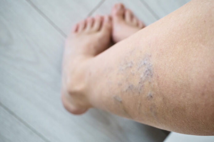 venu-operacija-venu-pazeidimai-apatineje-kojoje Venų operacija – matomi venų pakitimai ir kraujotakos sutrikimo požymiai kojoje